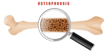 Osteoporosis
