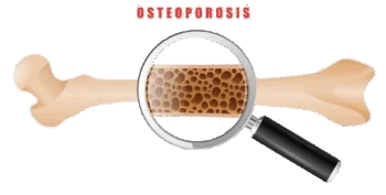 Osteoporosis